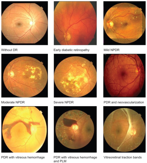 Some (sub)types of diabetic retinopathy. The competition grouped some together to get 5 ordered classes. (Click on image for source.)