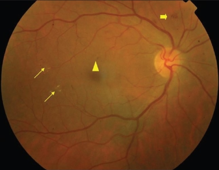 Example of non-proliferative diabetic retinopathy (NPDR): Thin arrows: hard exudates; Thick arrow: blot intra-retinal hemorrhage; triangle: microaneurysm.